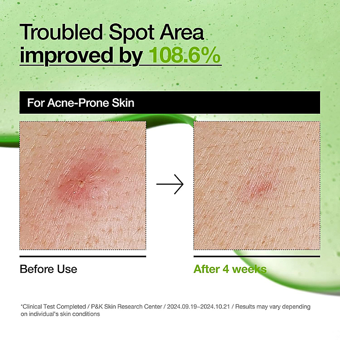 Ser calmant anti-roseata pentru piele sensibila Azelaic Acid 10 Hyaluron Redness Soothing