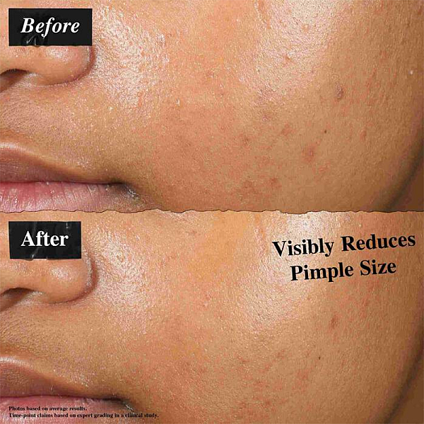 Solutie anti-imperfectiuni cu acid salicilic si niacinamide Truly Targeted Blemish-Clearing Solution