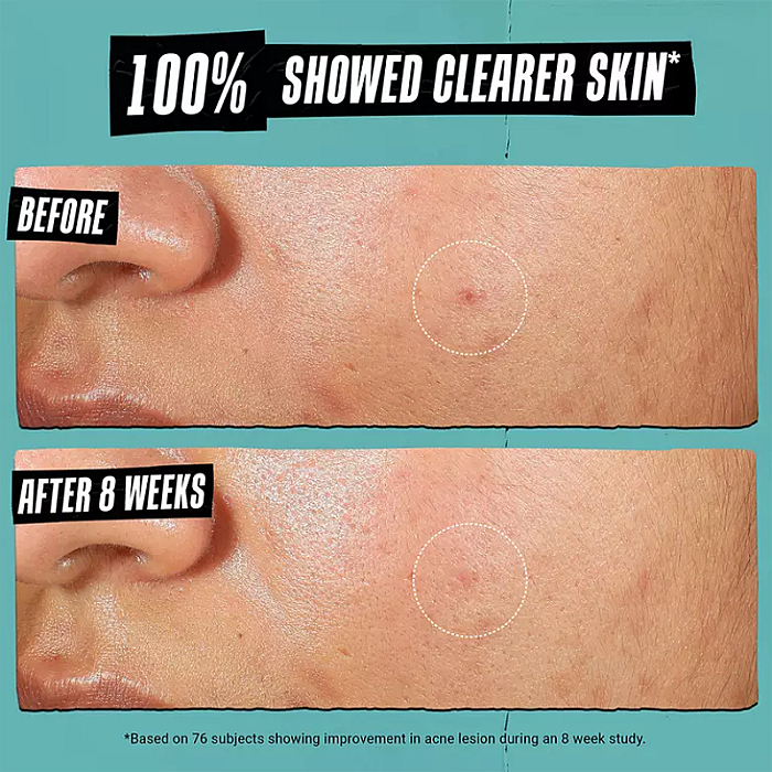 Crema anti-imperfectiuni cu acid salicilic si niacinamide Expertly Clear Blemish-Treating & Preventing Lotion