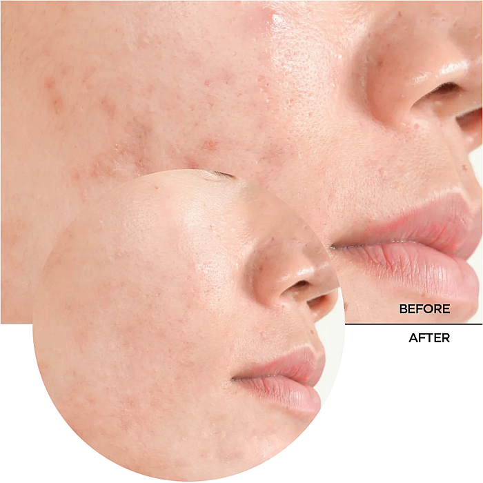 Ser exfoliant cu acid salicilic Just Salicylic Acid 2%