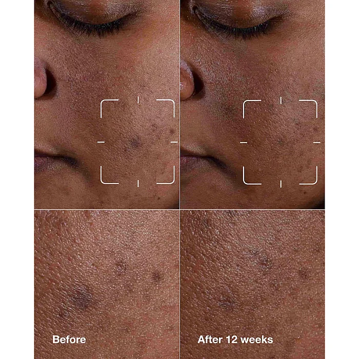 Ser iluminator anti-pete Even Better Clinical Dark Spot Clearing
