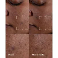 Ser iluminator anti-pete Even Better Clinical Dark Spot Clearing