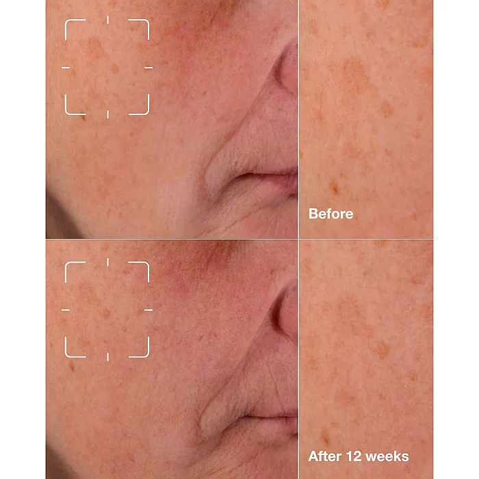 Ser iluminator anti-pete Even Better Clinical Dark Spot Clearing