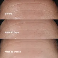 Ser concentrat antirid Smart Clinical Repair Wrinkle Correcting Serum